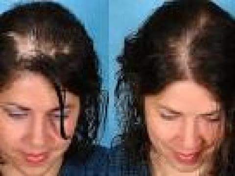 Hair Loss Recovery